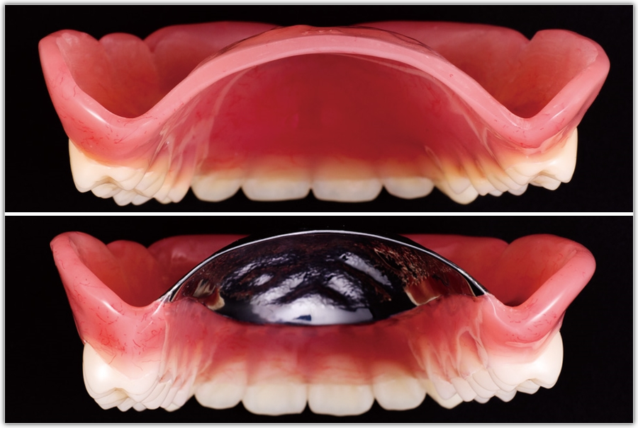 プラスチックの入れ歯と金属の入れ歯の比較