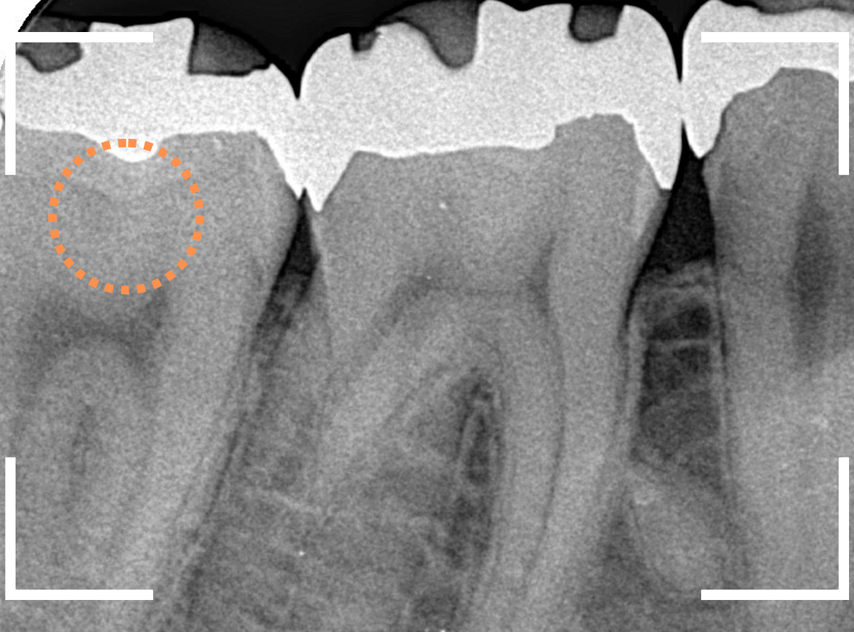 レントゲンでわかりづらい虫歯14-2