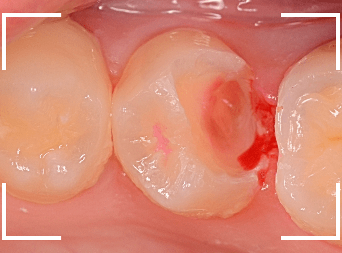歯と歯の間の虫歯12-4