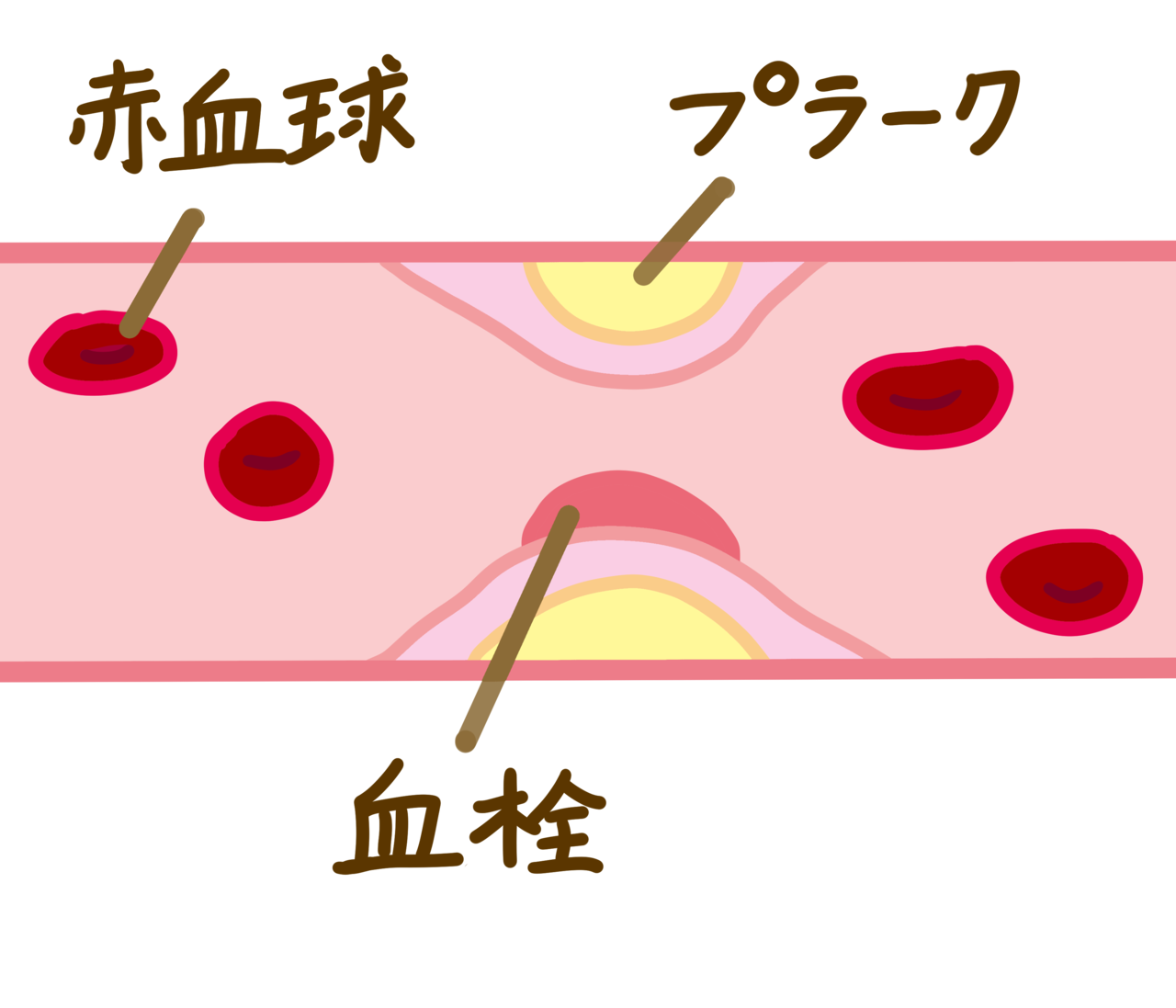 心筋梗塞の血管