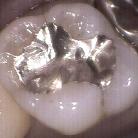 虫歯の治療ケース2(治療中1）