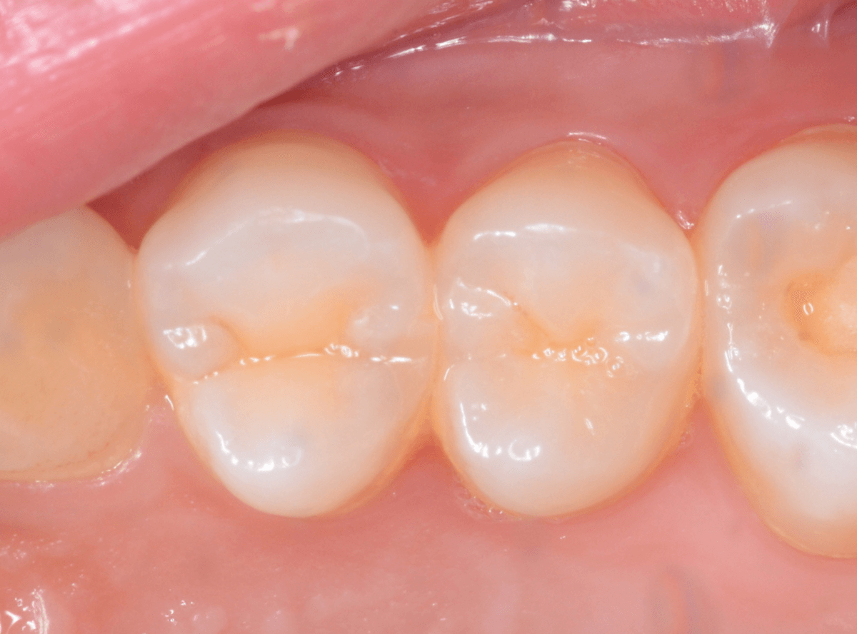 他の歯医者さんで虫歯と言われなかった虫歯の話(画像)1