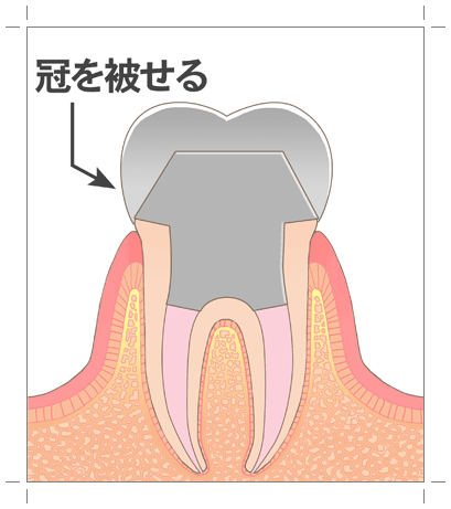 クラウンセット