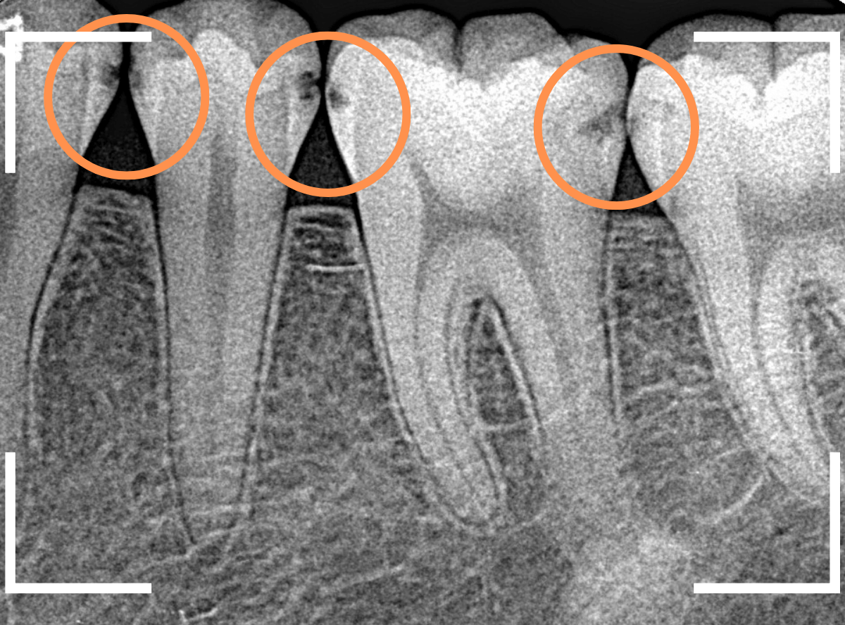 歯と歯の間の虫歯13-1
