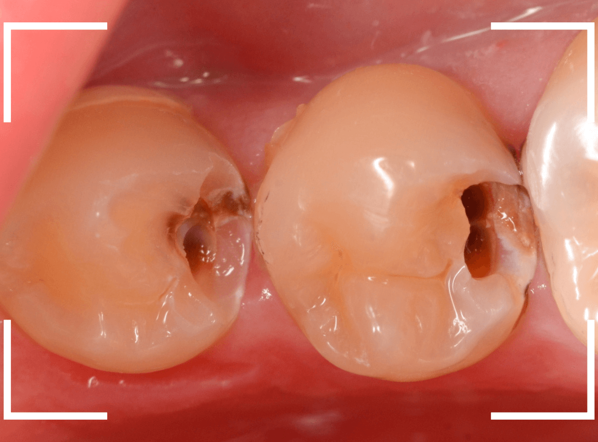 歯と歯の間の虫歯13-3