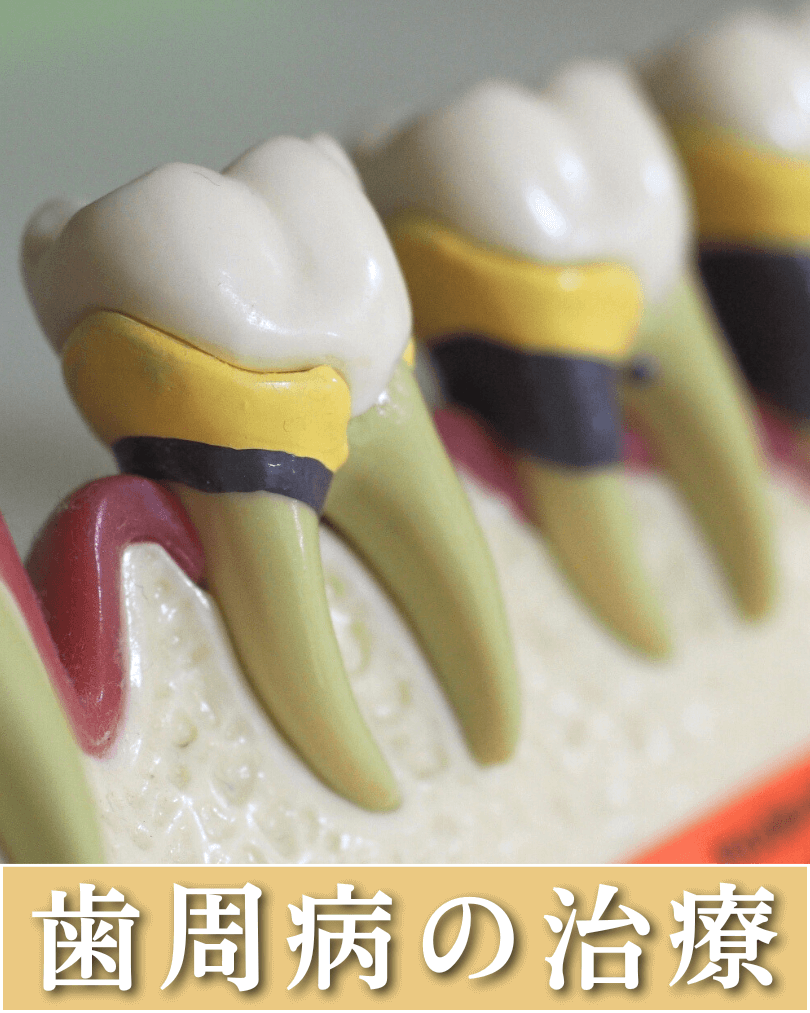 歯周病の治療