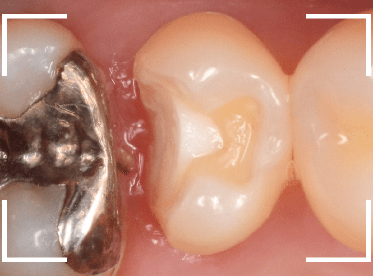 歯と歯の間の虫歯10-5