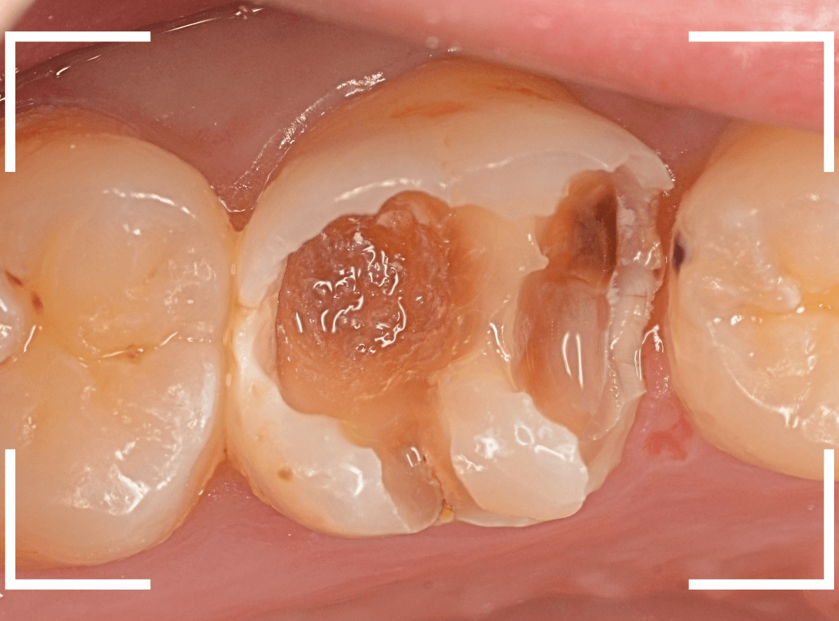気づかないうちに深い虫歯11-3