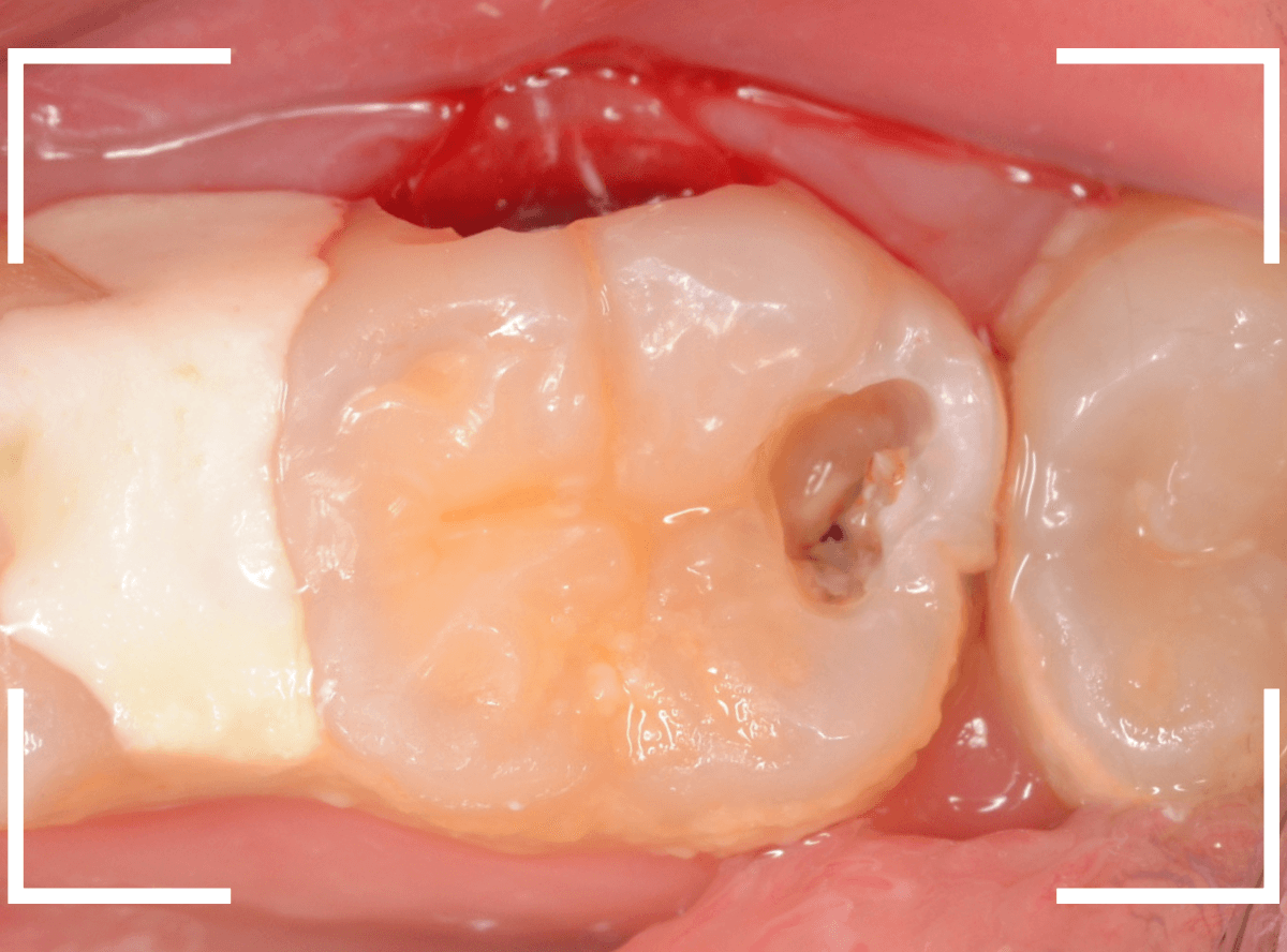 歯と歯の間の虫歯12-6