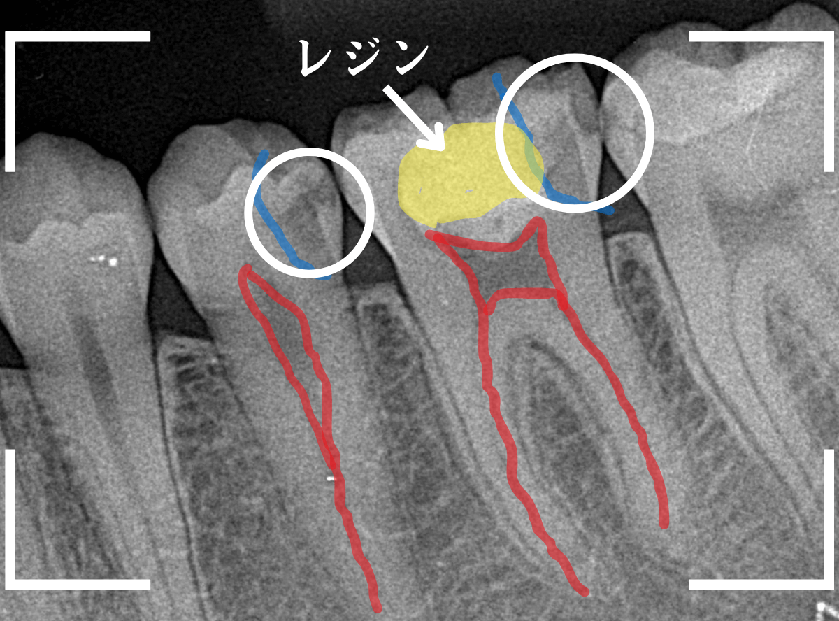 歯と歯の間の虫歯12-1