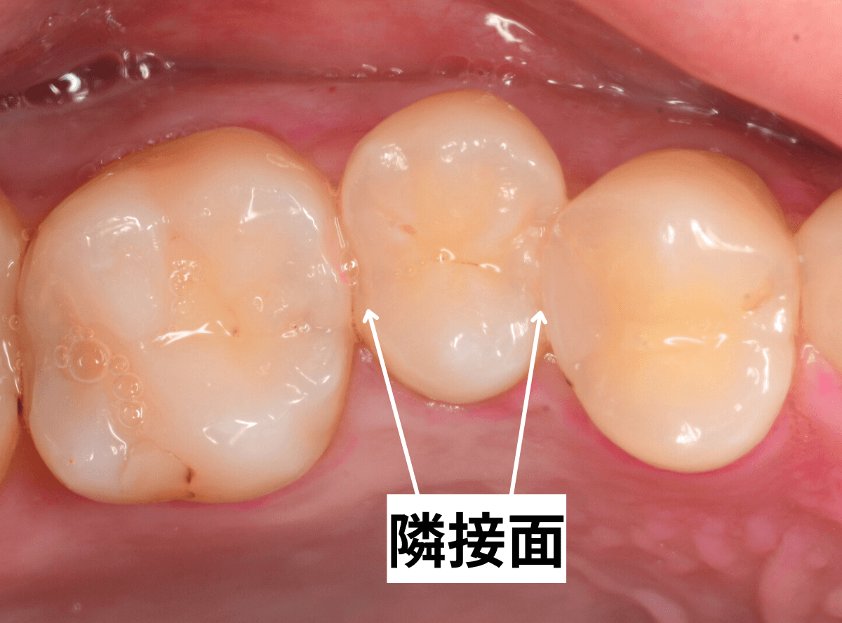隣接面の写真