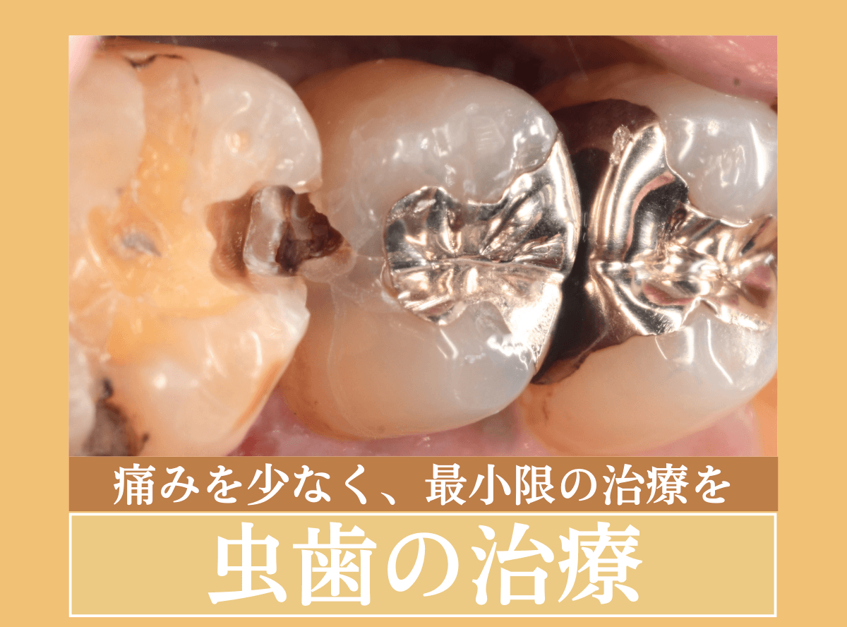 虫歯の治療のリンク