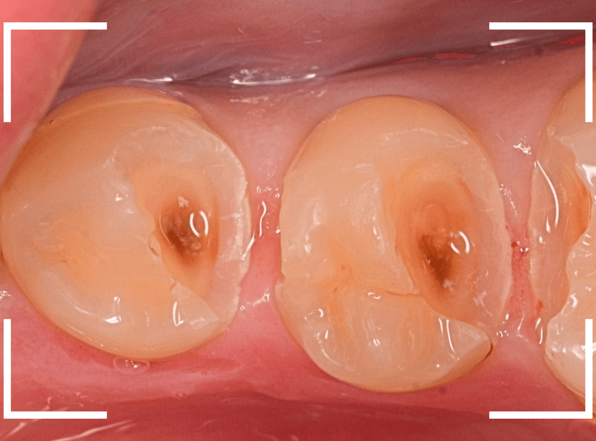 歯と歯の間の虫歯13-4