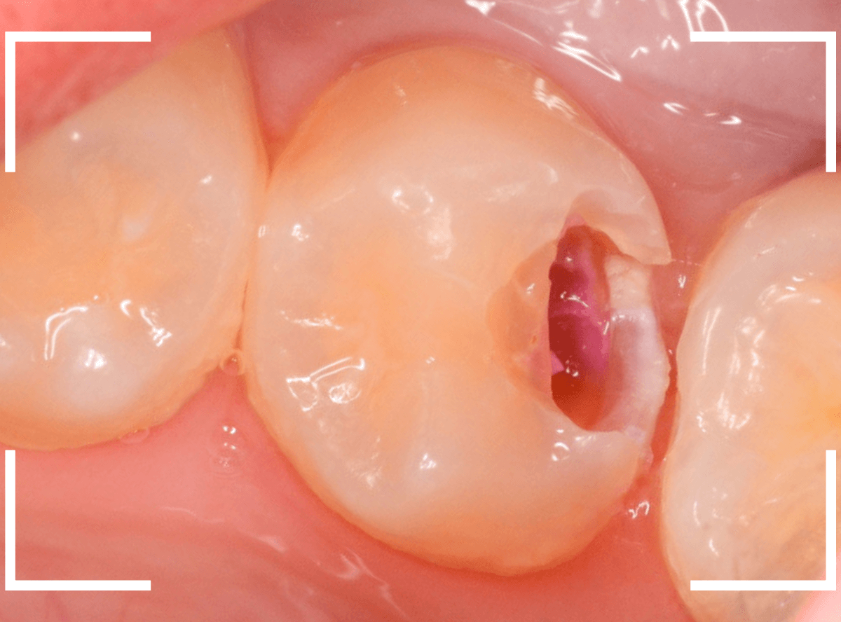 歯と歯の間の虫歯12-3
