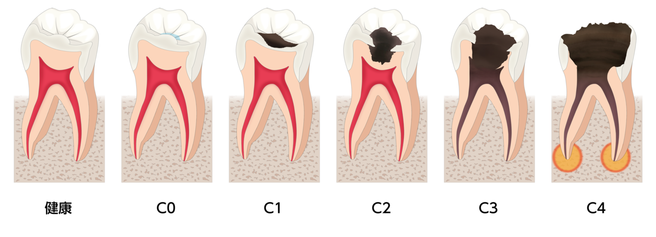 虫歯の進行段階と治療法