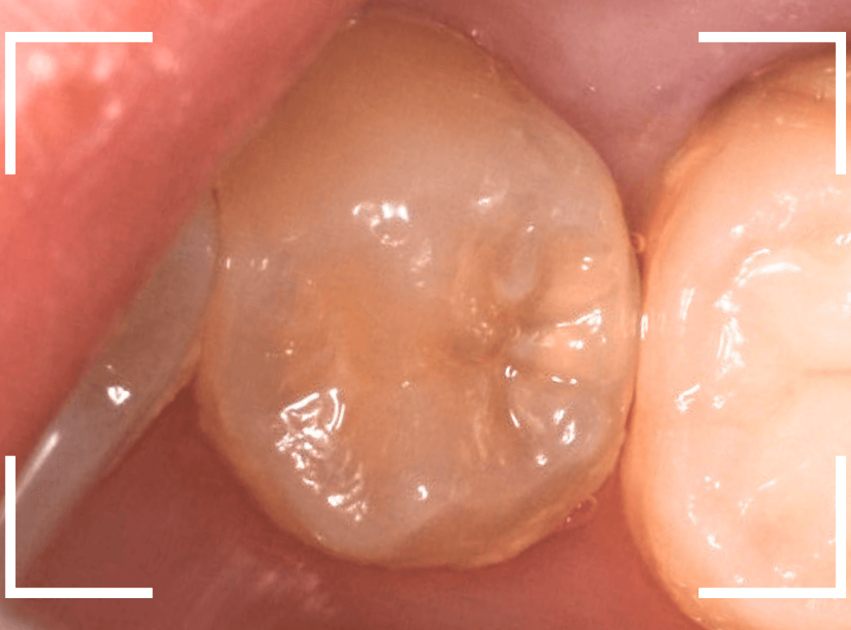 歯と歯の間の虫歯12-2