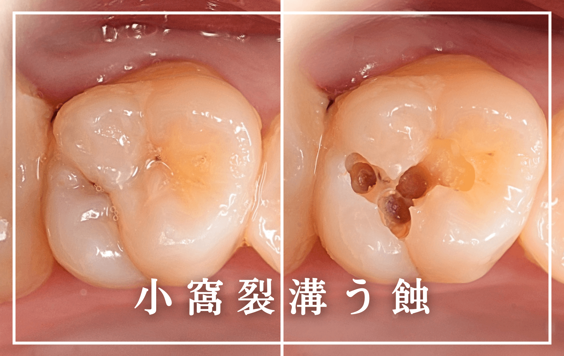 小窩裂溝う蝕