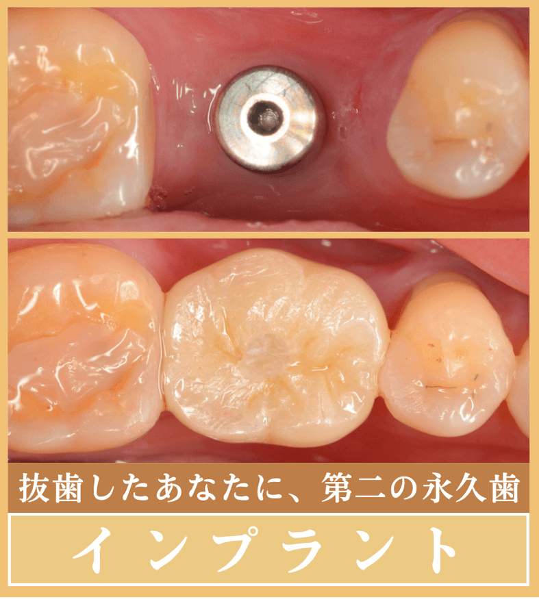 インプラント