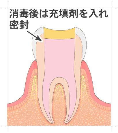 根管充填