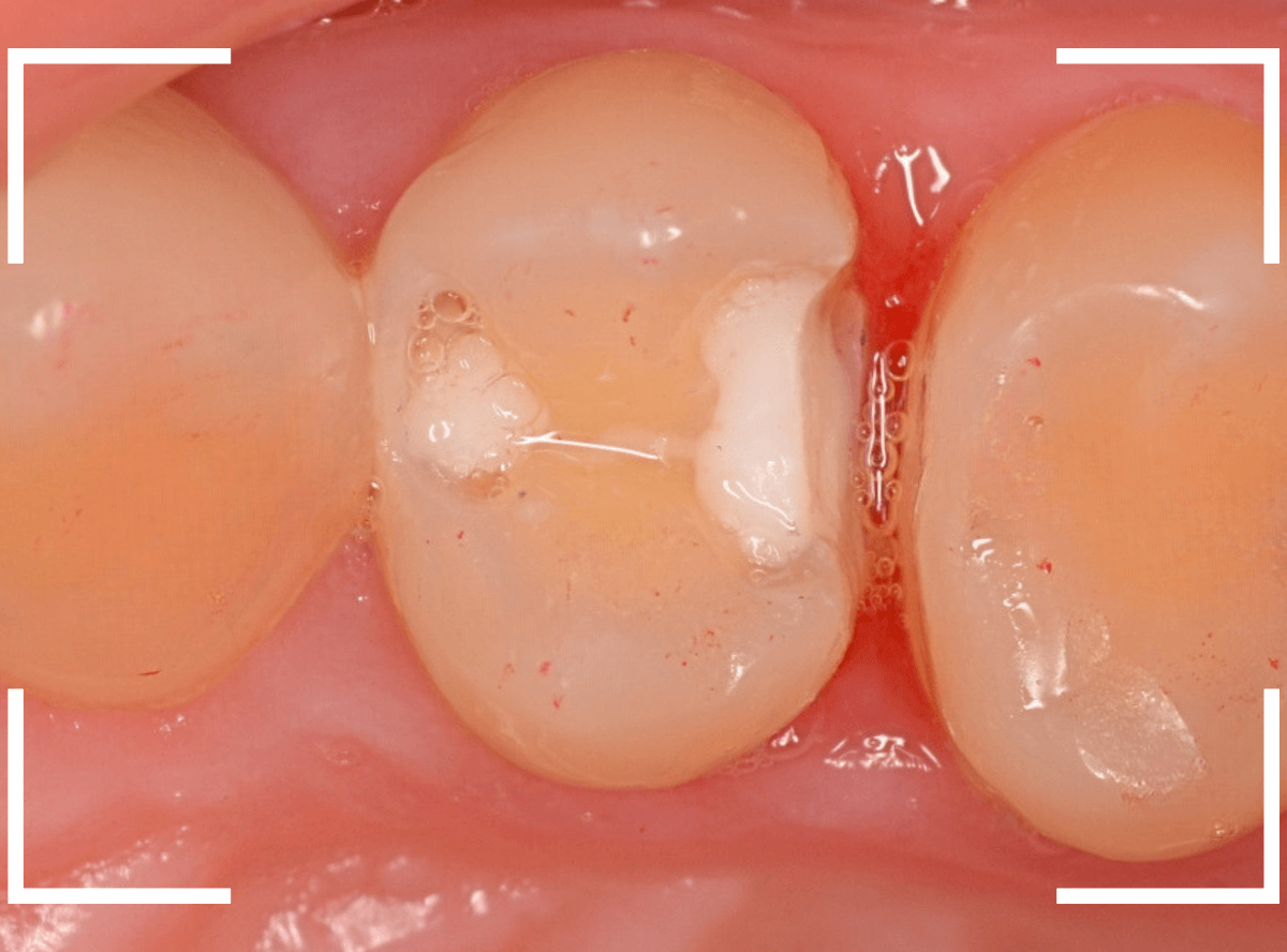 歯と歯の間の虫歯7-4
