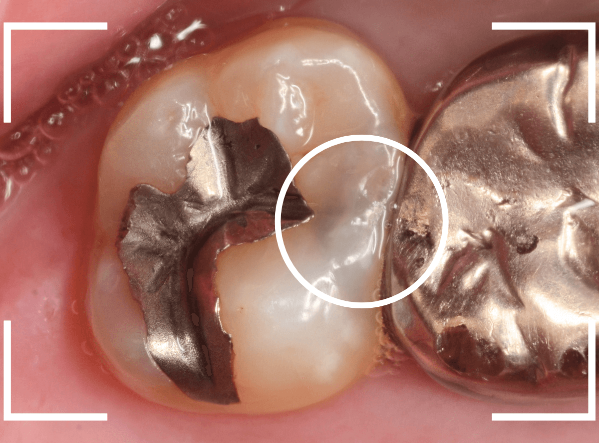 歯と歯の間の虫歯14-1