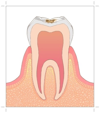 虫歯(C0~1)
