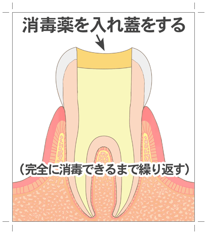 根管貼薬