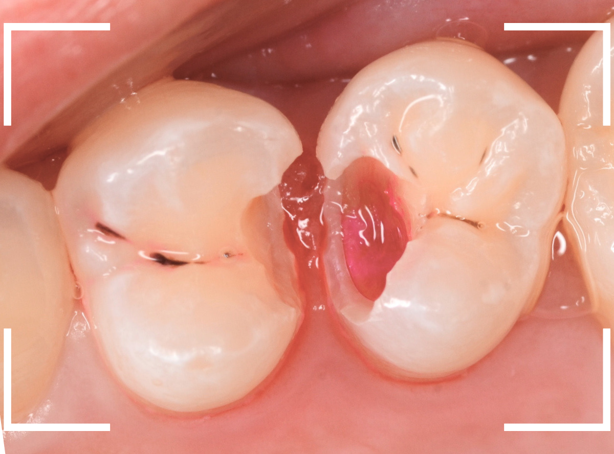 歯と歯の間の虫歯11-4