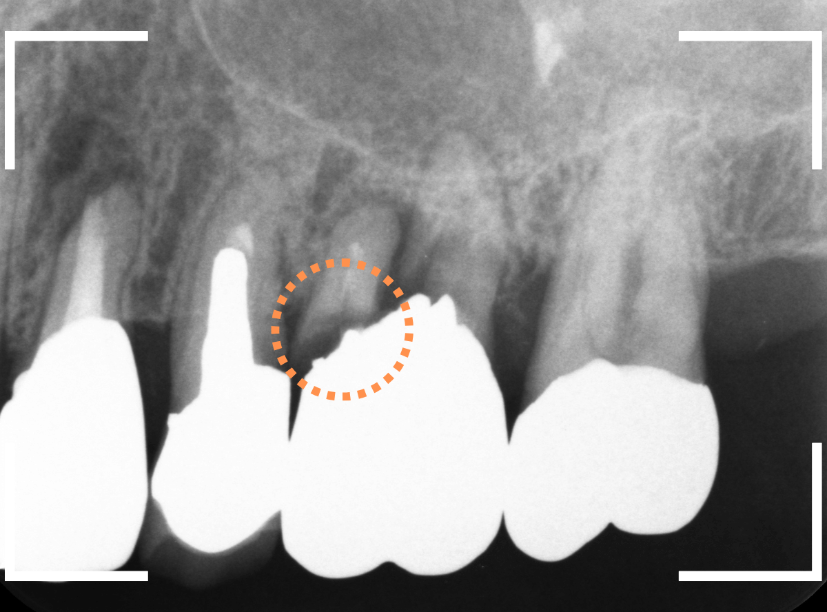 歯根破折6-2