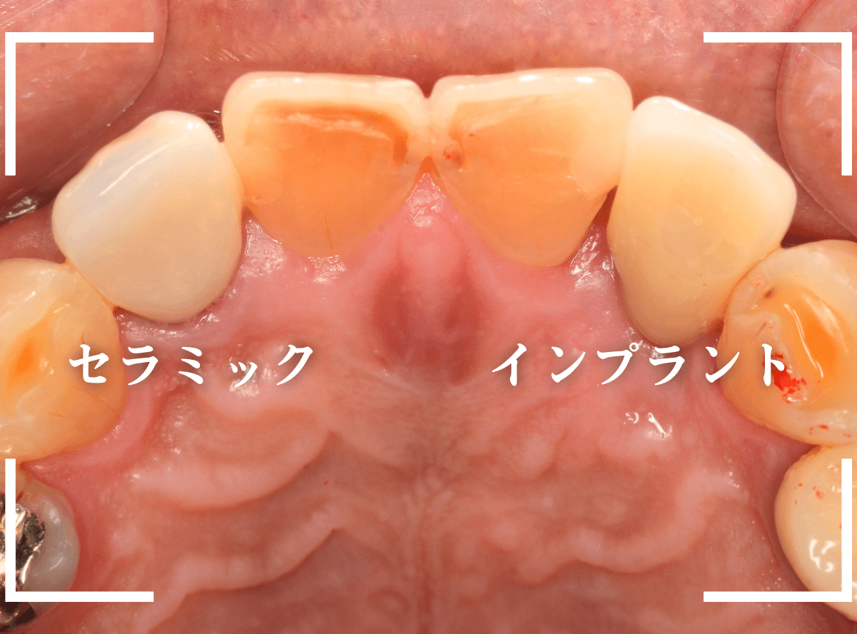 インプラント治療の実際1-10