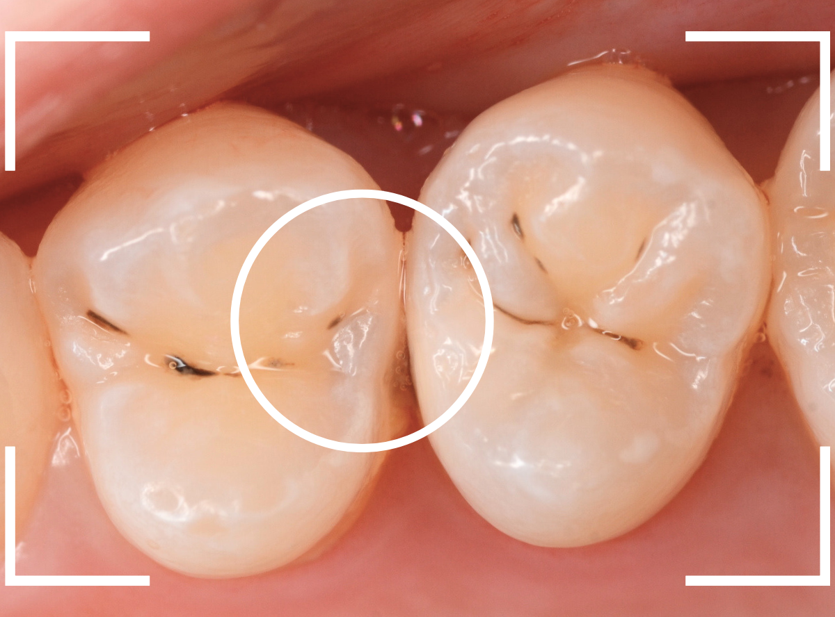 歯と歯の間の虫歯11-2