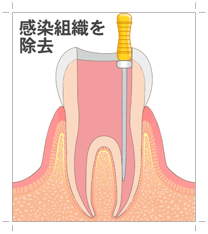 抜髄