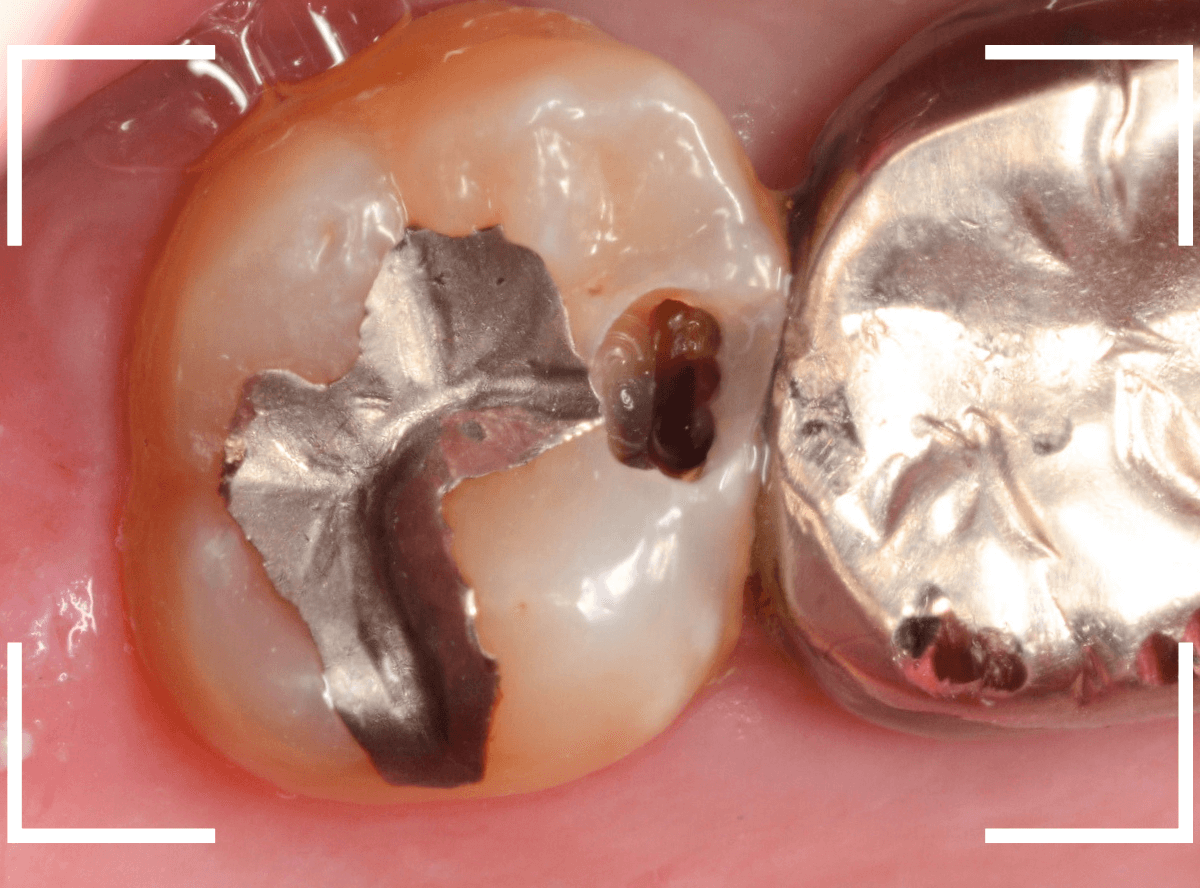 歯と歯の間の虫歯14-3