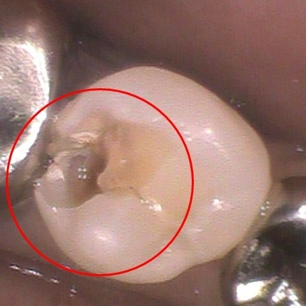 虫歯の治療ケース1(治療中）