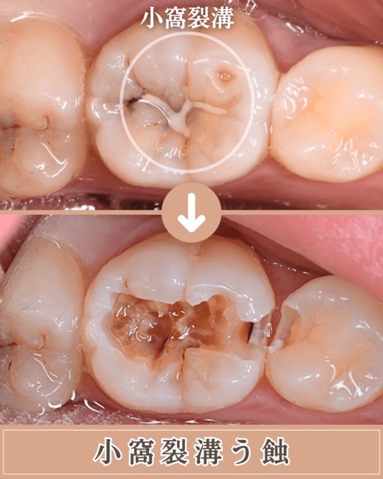 小窩裂溝う蝕の画像