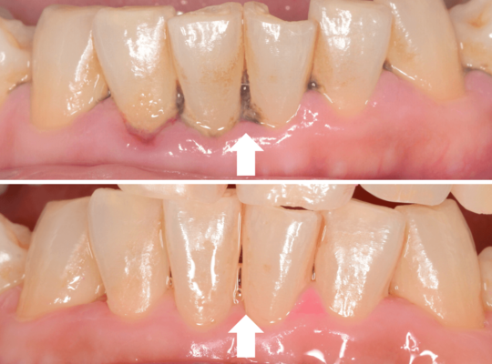歯肉の中の歯石（歯肉縁下歯石）除去 - 高円寺駅PAL歯科医院｜JR高円寺駅南口すぐ徒歩2分の歯医者さん