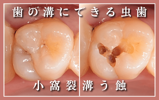 小窩裂溝う蝕