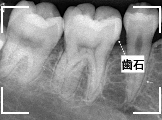 レントゲンでわかりづらい虫歯4-2