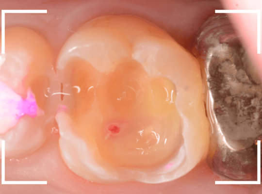 つめものの下の深い深い虫歯20-1