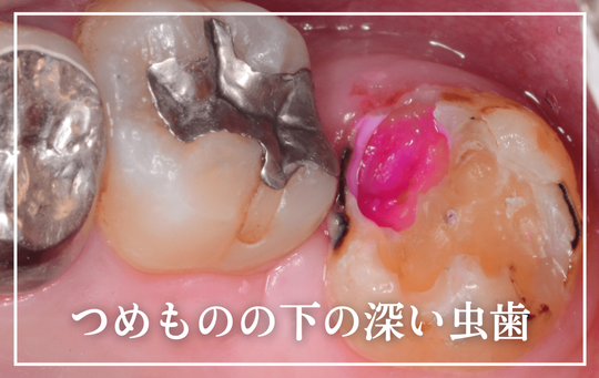 つめものの下の深い虫歯（二次う蝕）
