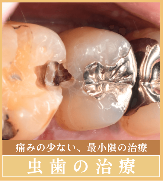 虫歯の治療