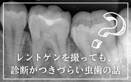 レントゲンでわかりづらい虫歯－タイトル