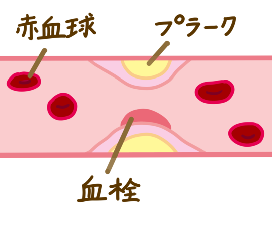 心筋梗塞の血管