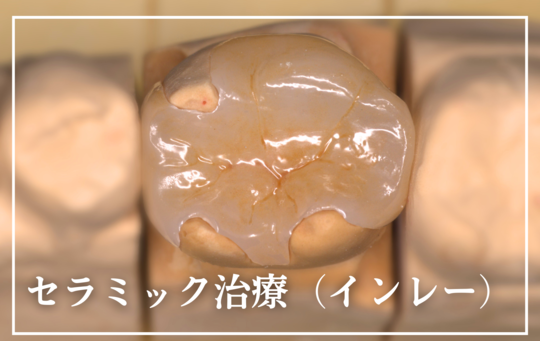 セラミック治療(インレー)-タイトル