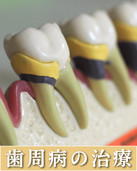歯周病の治療