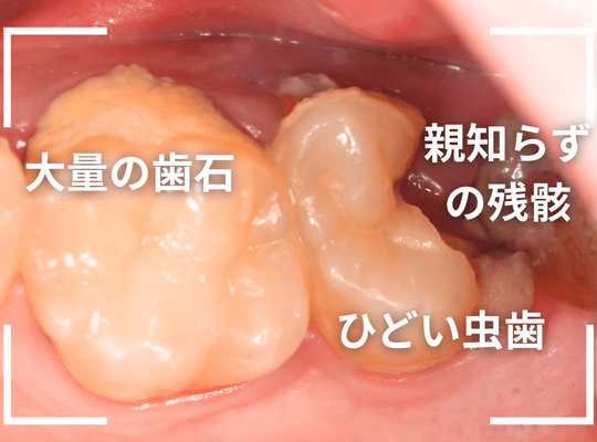 虫歯を放置して、抜歯7-2