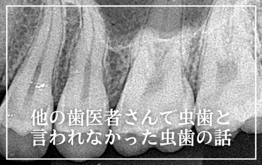 他の歯医者さんで、虫歯と言われなかった虫歯の話
