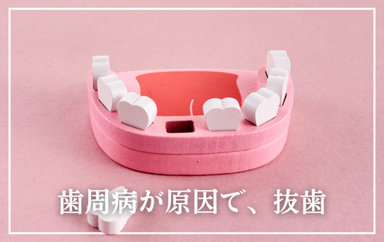 歯周病が原因で、抜歯