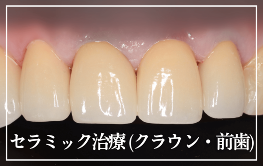 セラミック治療(クラウン・前歯)-タイトル