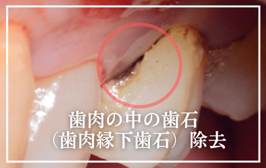 歯肉の中の歯石除去_タイトル